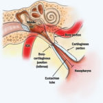 Eustachian Tube Balloon Dilation | Risks | Symptoms | FAQ