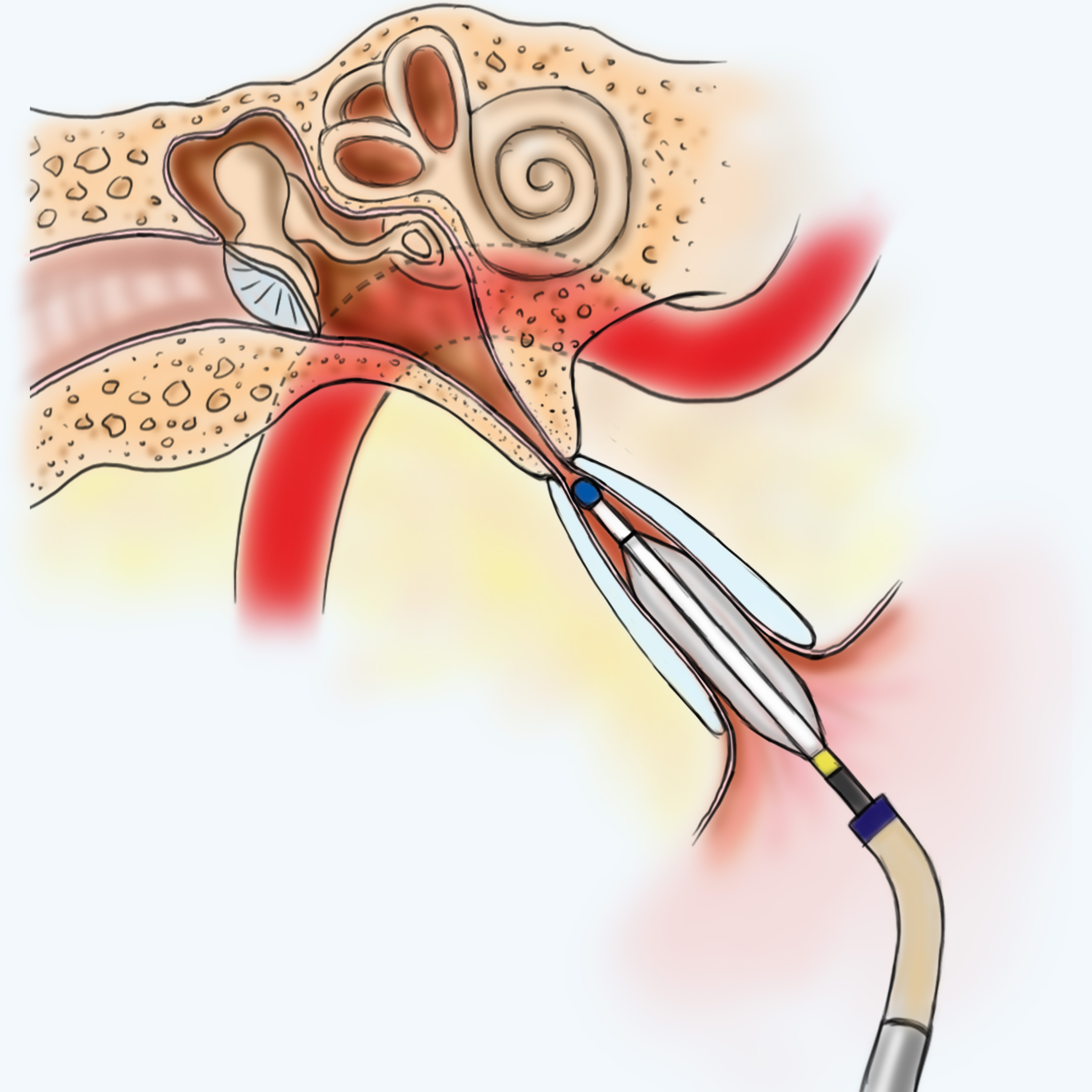 Eustachian Tube Balloon Dilation Risks Symptoms FAQ