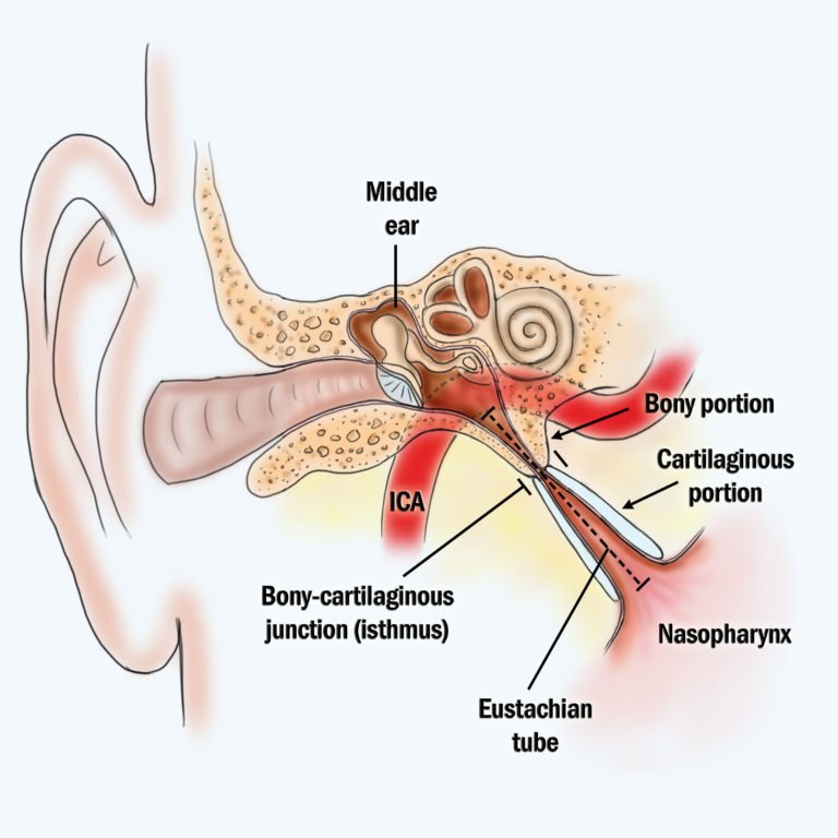 Eustachian tube balloon dilation risks symptoms faq