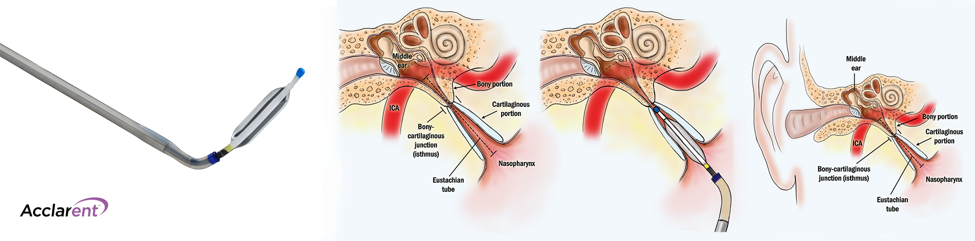 Eustachian Tube Balloon Dilation Risks Symptoms Faq