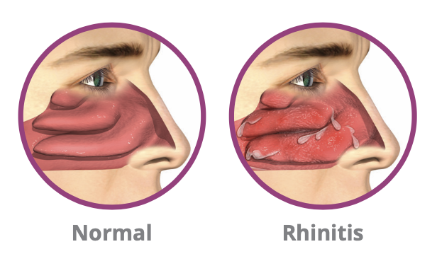 Chronic Rhinitis vs Normal Nose