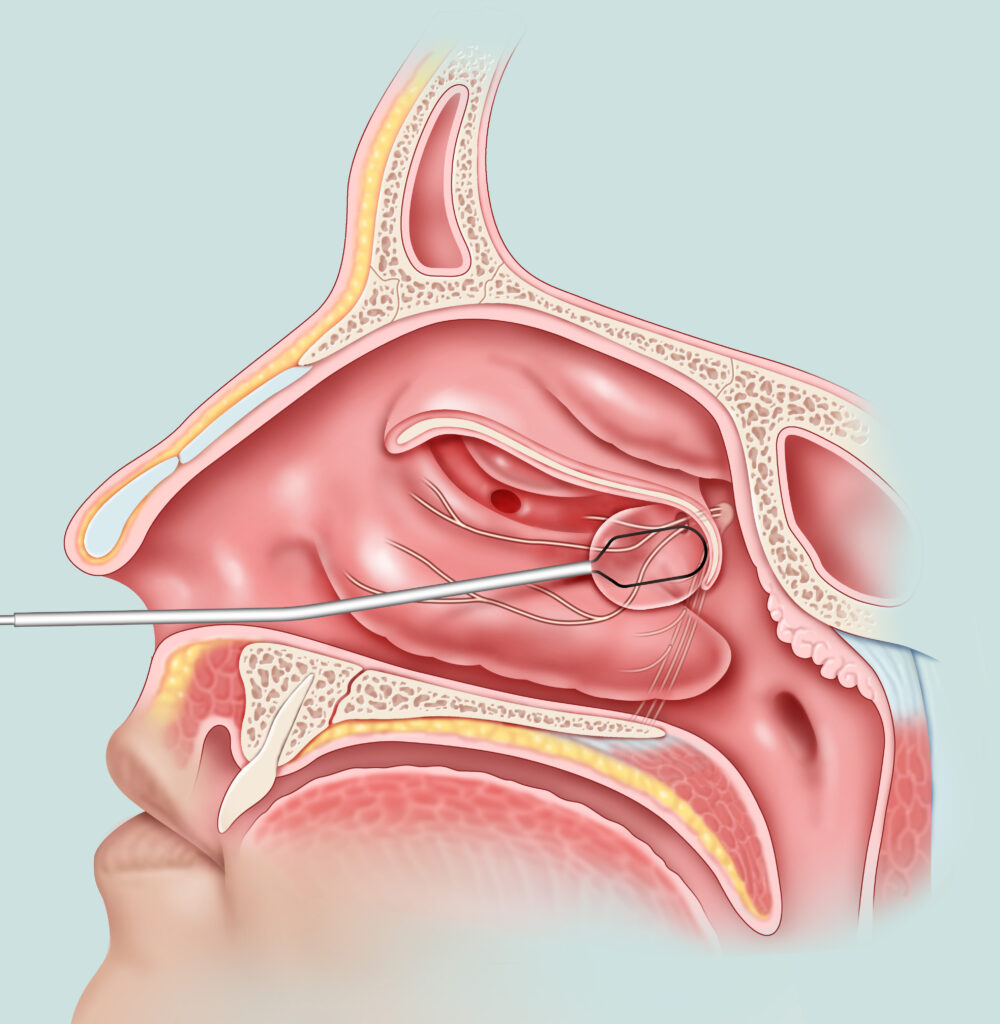 runny nose anatomy