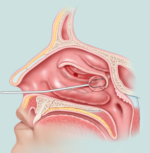 Clarifix Sinus Treatment