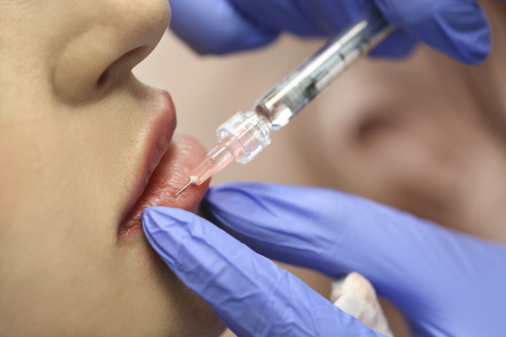 woman-getting-lip-filler-injection